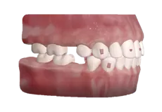 Classic Tooth Extraction Protocol