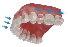 Classic Molar Distalization Protocol