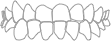Crossbite