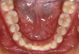 Intraoral photos