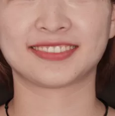 Facial photos before treatment