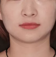 Facial photos before treatment