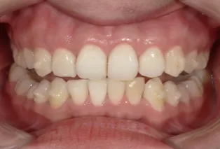 Intraoral photos