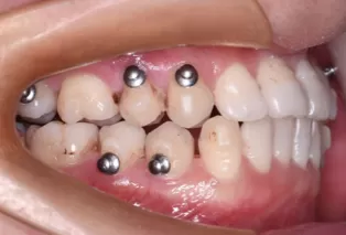 Intraoral photos