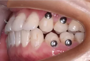 Intraoral photos