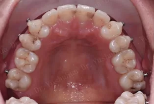 Intraoral photos