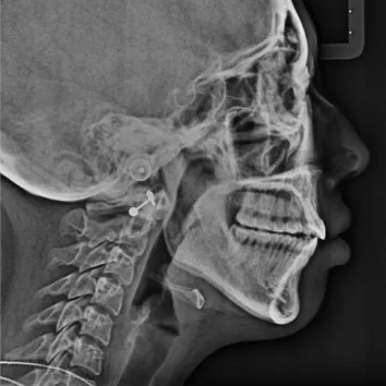X-rays after treatment