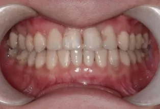 Intraoral photos after treatment