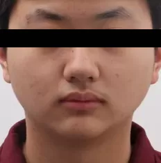 Facial photos before treatment