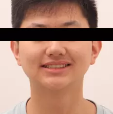 Facial photos before treatment