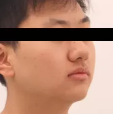 Facial photos before treatment