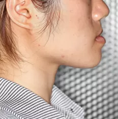 Facial photos before treatment