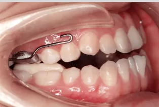 Intraoral photos