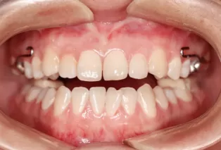 Intraoral photos