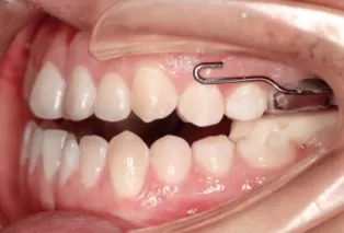 Intraoral photos