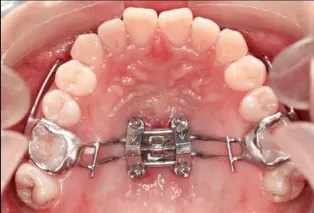 Intraoral photos