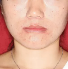 Facial photos before treatment