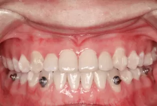 Intraoral photos after treatment