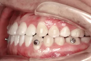 Intraoral photos after treatment