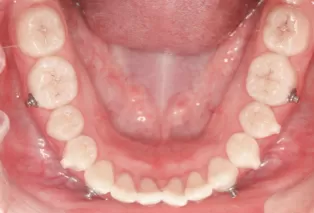 Intraoral photos after treatment