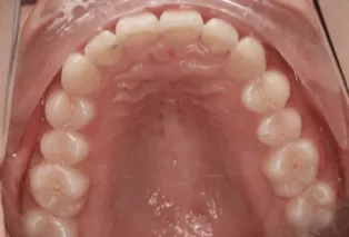 Intraoral photos after treatment