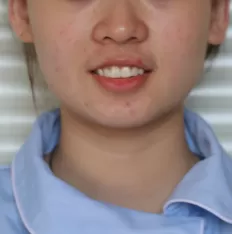 teeth-invisible-aligners-2.png