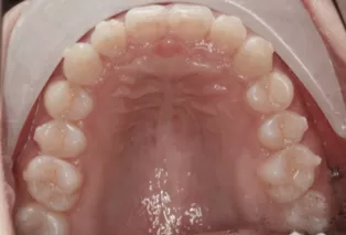 Intraoral photos