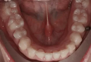 Intraoral photos