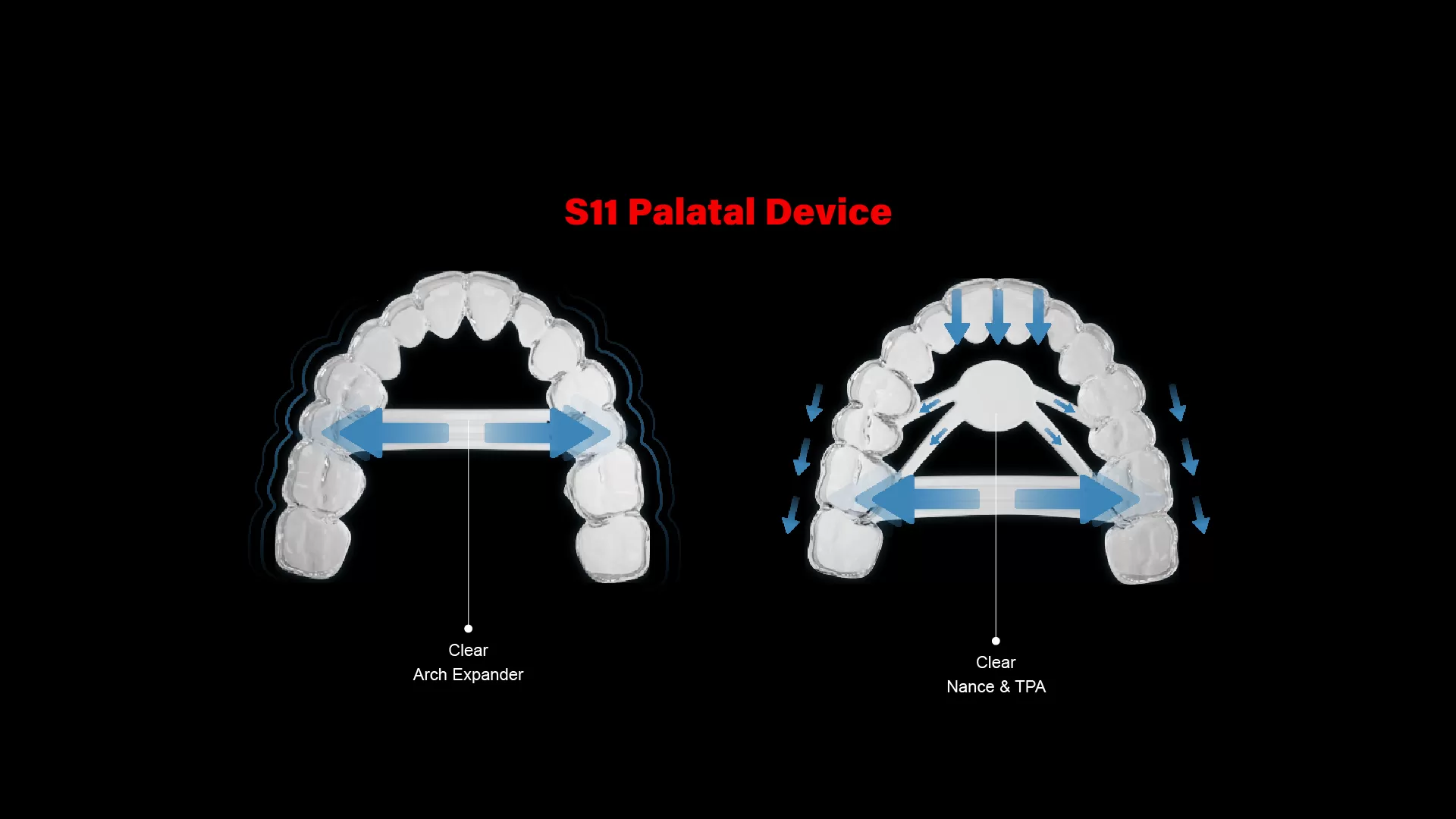 S11 Palatal Device