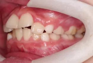 Intraoral photos