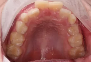 Intraoral photos
