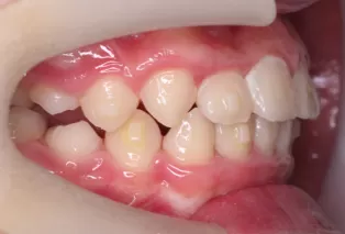 Intraoral photos
