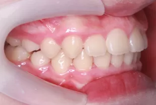Intraoral photos after treatment