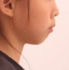 Facial photos before treatment