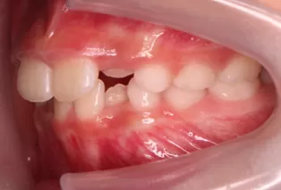 Intraoral photos