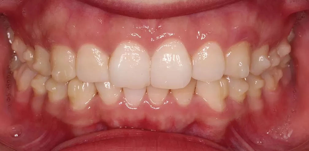 S8-SGTB Mandibular advancement