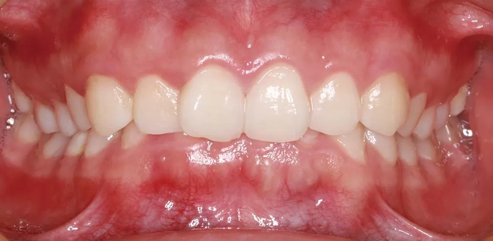 S8-SGTB Mandibular advancement