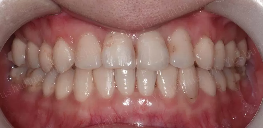 S10 Correct Anterior Crossbite