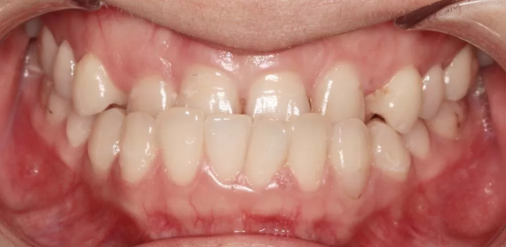 S10 Correct Anterior Crossbite