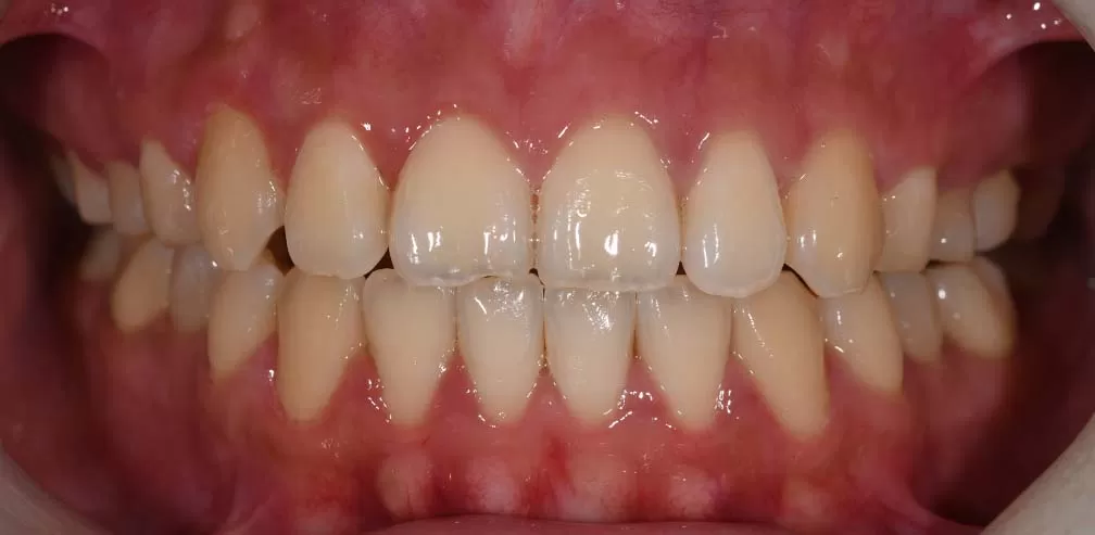 S8-SGHB Correct Anterior Openbite