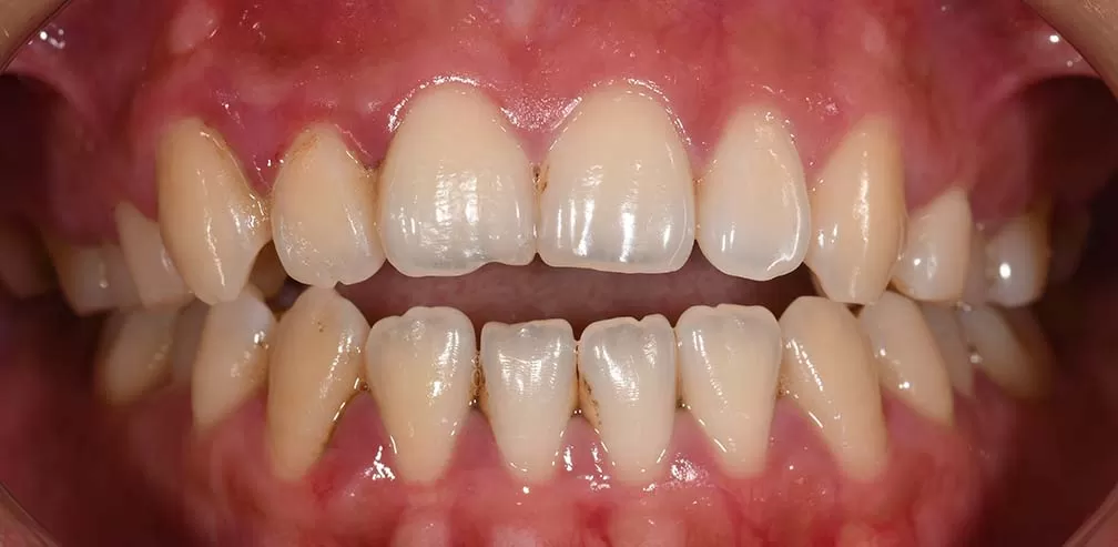 S8-SGHB Correct Anterior Openbite