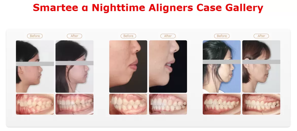 night aligner.png night aligner.png
